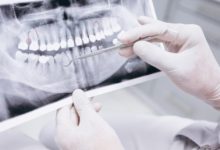 Photo of Implanty stomatologiczne wpływają korzystnie na cały zgryz?