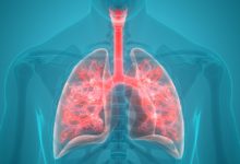 Photo of Eksperci: zapalenie płuc nie zawsze jest u nas leczone zgodnie z zasadami medycyny opartej na faktach